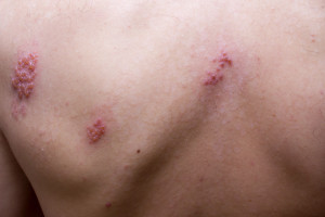 Man's back with shingles outbreak.